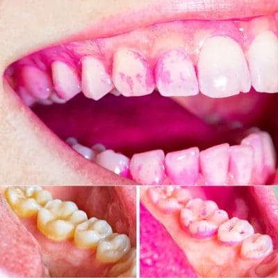 Disclosing Tablets - Plaque Search - Smile Boosters